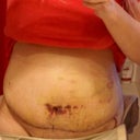 Day 6. Extremely swollen.