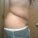 3 wks higher scar on right side with bulge