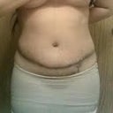 3 wks, here you can see the unevenness of the scar and fat distribution---will probably need a revision :(