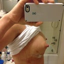 3 day PO w/ bruising