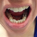 Before - Bottom teeth, extremely crowded.