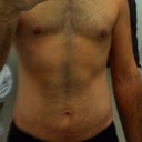 Pre Op - This is about a month ago, just finished at the gym so looks better than most days!