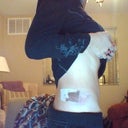 Harvest site one day post op