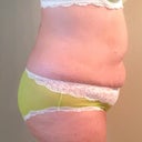 Hours before surgery.