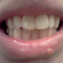 Before, please note I do have a flaw in my front tooth