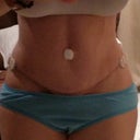 2 wks post op
