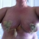 3 days post op