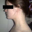 Two weeks after Vaser surgery