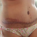 11 days post op, right side. Ouch, that rash!