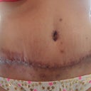 11 days post op, straight on. The skin pucker looks pretty awful! Will that go away?