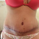 11 days post op, in my BIKINI <3 I love it! I love how my figure looks! Can't wait to hit the gym and tone up a bit more!