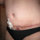 week 8 and you can see yet some more swelling has gone but PS said I am still quit swollen