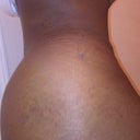 11days post...Dr.O gave me exactly what i wanted... !!