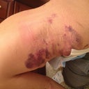 Lipo on Upper Back, Flanks and Outside of Thighs (Saddlebags)