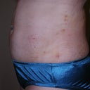 2 days post-surgery