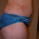2 days post-surgery. The bruises are where the garment was bunched up.