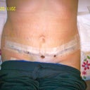 Day #4 post op tummy tuck...already see a huge difference.
