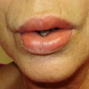 Lips with kenalog after silicone