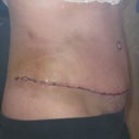 14 days PO (see the distention in lower ab)