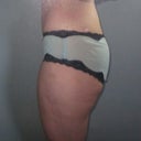 Before Surgery 5.13.12