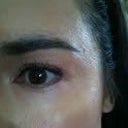 4 years after Sculptra, and 2 years after subscision procedure