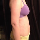 Post op day 9