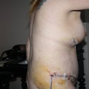 post-op day 7......8th June
Side view before shower.