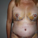 Post-op day 7...8th June
Front view before shower....still very swollen.