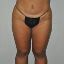 AFTER SMARTLIPO ON INNER THIGHS :)