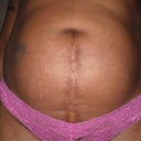 Close up of round belly & c-section scar