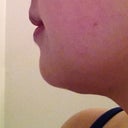 16 days post-op. The bulge under my chin is from the lumps that formed around day 12.