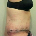 48 hrs side view