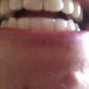 Invisalign Tray #1