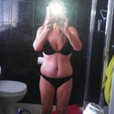 Day 15 Still alot of swelling and bruising but early days yet, Happy that you cannot see scar :)