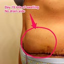 Swelling on side with no drain