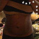 4 days post op