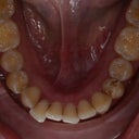 My bottom teeth before any orthodontic work.