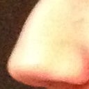 Left side before (the not so bad side) - normal nostril and dorsal hump