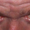 Looseness in eyelids...head tilted down.