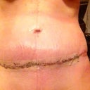 3 weeks PO still swollen