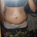 7 days post op!