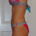 side view. 3 months post op