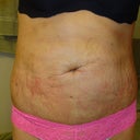 AFTER Front view 4th day of healing