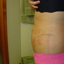 AFTER Left view 4th day of healing