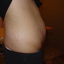 BEFORE Right Side Smartlipo MDX
