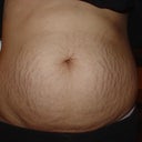 BEFORE Smartlipo MDX