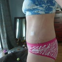 week 8 post op still swelling