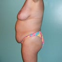 Before mommy makeover, side