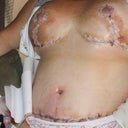 Day after surgery, mommy makeover