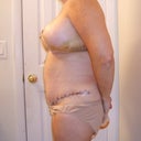 Five days post op, mommy makeover, side